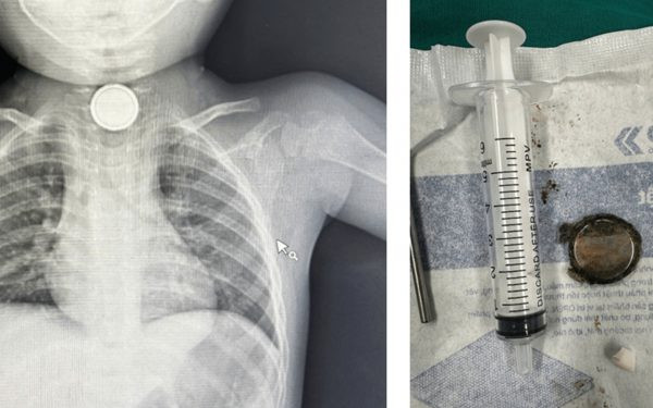 Phim chụp và viên pin sau khi được lấy ra ngoài. Ảnh: BVCC