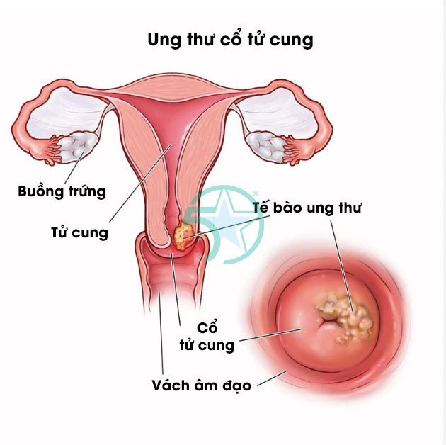Ung thư cổ tử cung là căn bệnh ác tính nguy hiểm