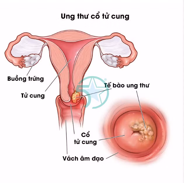Ung thư cổ tử cung là căn bệnh ác tính nguy hiểm