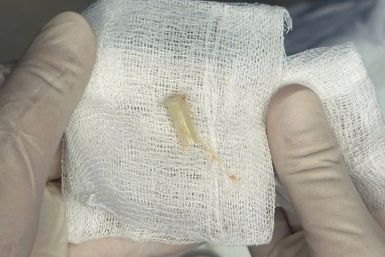 Chiếc kèn nhựa sau khi được lấy ra khỏi cơ thể bệnh nhi. Ảnh Báo Sức khoẻ và Đời sống