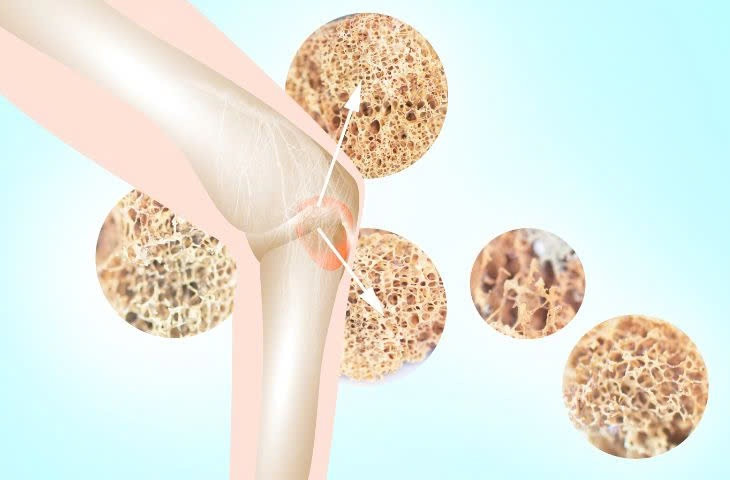 Loãng xương diễn biến âm thầm nhưng có thể gây biến chứng nặng nề là gãy xương nên việc phát hiện và điều trị sớm là vô cùng quan trọng. Ảnh minh họa
