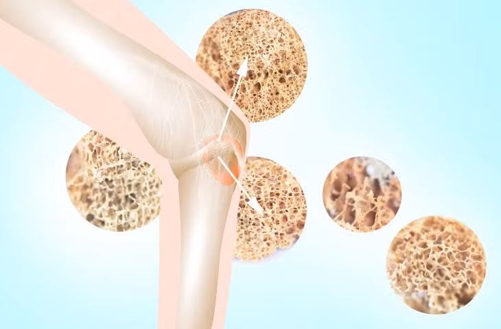 Loãng xương diễn biến âm thầm nhưng có thể gây biến chứng nặng nề là gãy xương nên việc phát hiện và điều trị sớm là vô cùng quan trọng. Ảnh minh họa