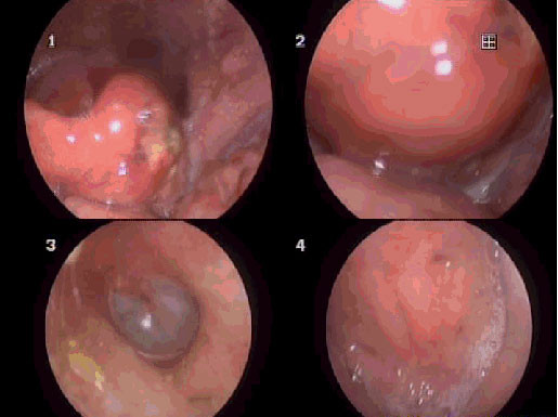 Hình ảnh phù nề hạ họng của người bệnh. Ảnh BVCC Hình ảnh phù nề hạ họng của người bệnh. Ảnh BVCC