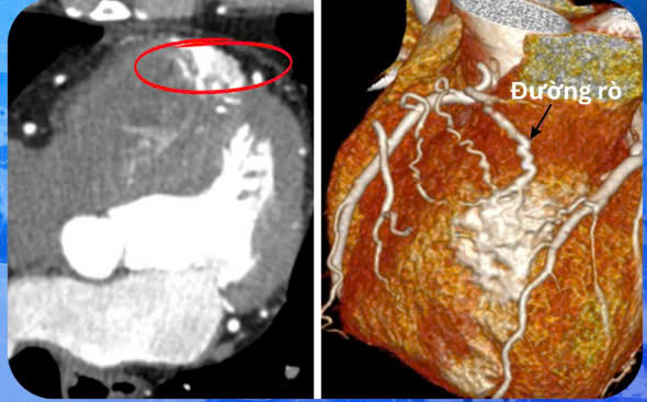 Hồi hộp, tức ngực, đi khám phát hiện bất thường ở tim. Ảnh BVCC