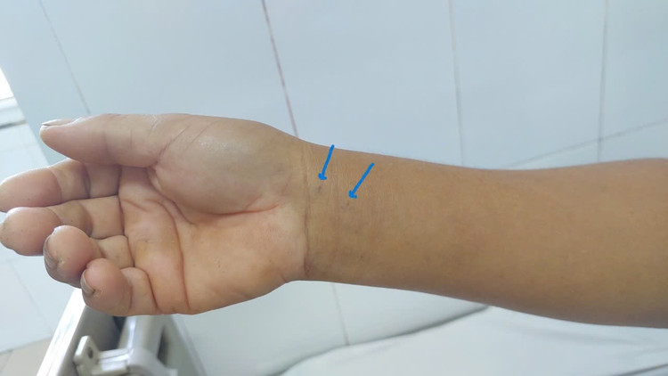 ️Vết răng rắn cắn trên cổ tay bệnh nhân D. Ảnh BVCC