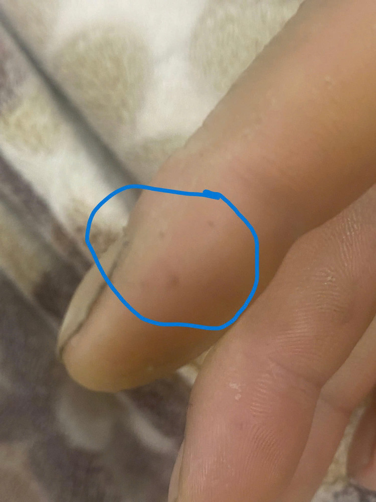 Vết răng rắn cắn trên ngón tay bệnh nhân Th. Ảnh BVCC