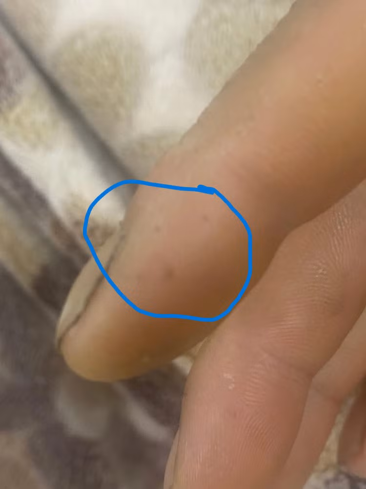 Vết răng rắn cắn trên ngón tay bệnh nhân Th. Ảnh BVCC