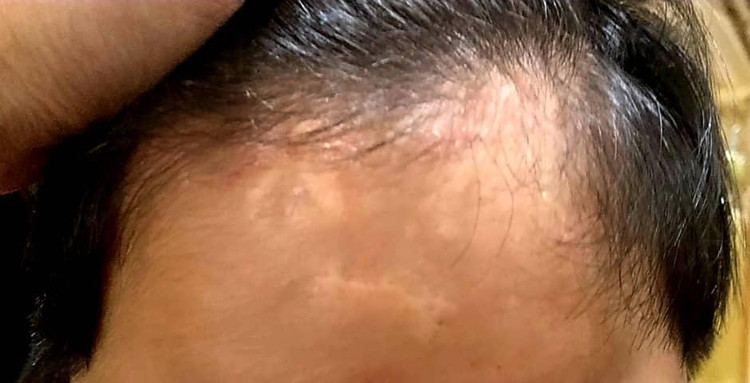 Thương tích trên cơ thể cháu H. nghi do bị bạo hành trong quá trình được ông Lê Minh Quang trị bệnh chậm phát triển.