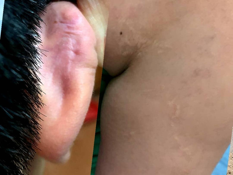 Một trong số hàng chục vết sẹo vẫn còn trên cơ thể cháu H.