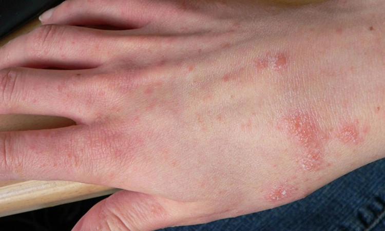 &quot;Điểm mặt&quot; 5 bệnh về da dễ gặp vào mùa mưa. Ảnh minh họa