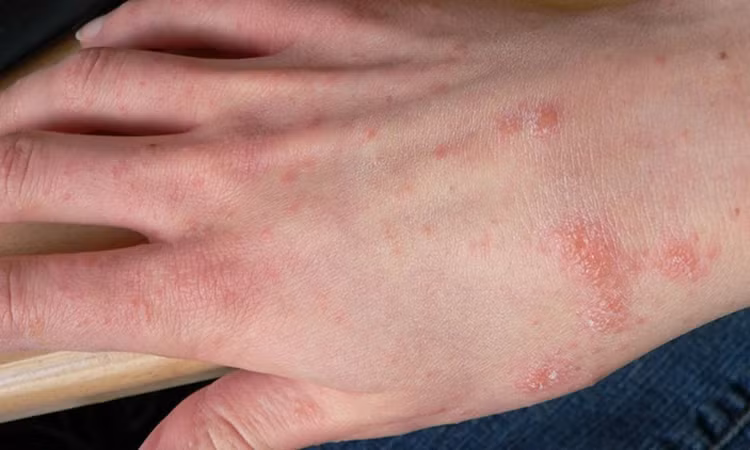 "Điểm mặt" 5 bệnh về da dễ gặp vào mùa mưa. Ảnh minh họa