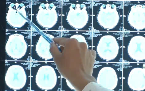 Đau đầu, nhìn 1 thành 2,... đi khám bất ngờ phát hiện đột quỵ tuyến yên. Ảnh BVCC