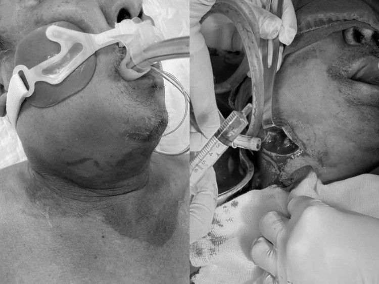 Ổ áp vùng dưới hàm phải của bệnh nhân. Ảnh BVCC