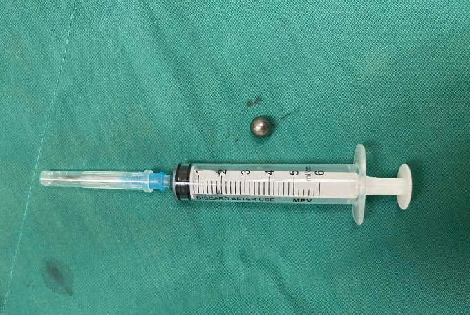 Hình ảnh viên bi được lấy ra ngoài. Ảnh BVCC