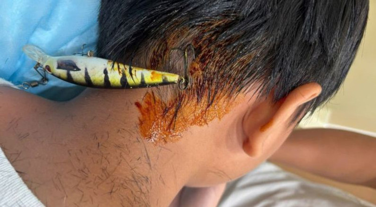 Móc câu cá đâm vào gáy bệnh nhi. Ảnh PKCC