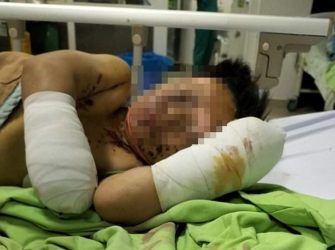 Bé P.Đ.C bị mất 2 bàn tay sau vụ nổ.