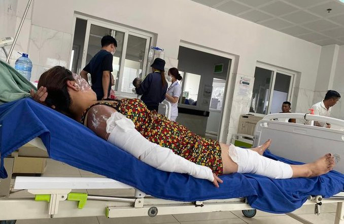 Bệnh nhân trong vụ nổ nhập viện với nhiều vết bỏng trên cơ thể.