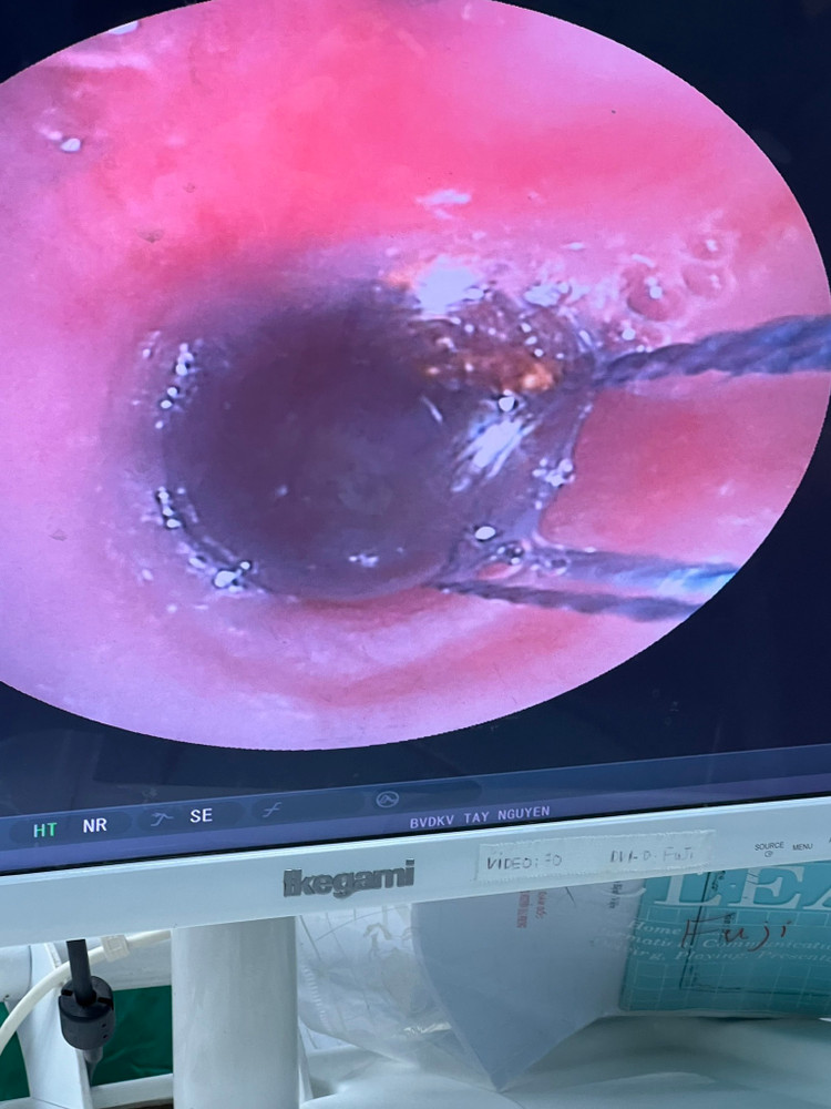 Dị vật nằm trong đường thở. Ảnh BVCC Dị vật nằm trong đường thở. Ảnh BVCC