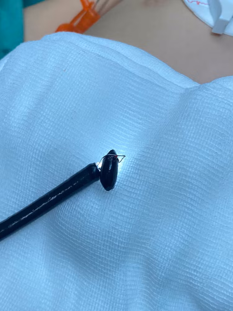 Hạt na sau khi được gắp ra. Ảnh: BVCC