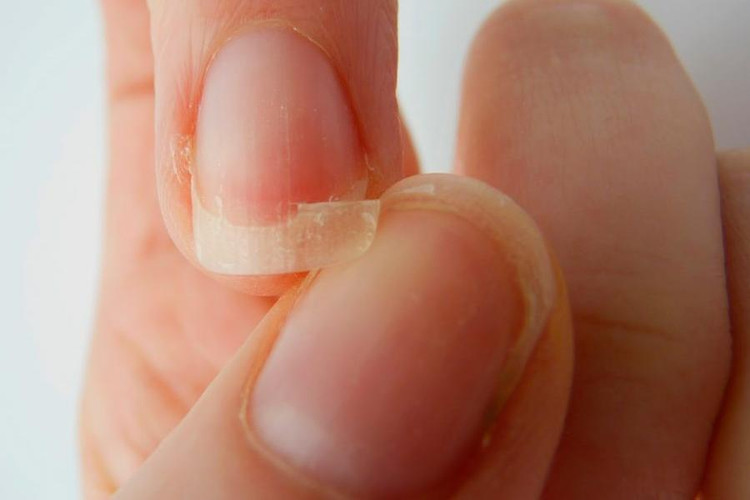 Móng tay mềm, yếu, dễ gãy thiếu chất gì? Ảnh minh họa