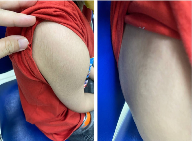 Trẻ đột nhiên xuất hiện tình trạng mọc lông bất thường tại nhiều bộ phận trên cơ thể. Ảnh PKCC