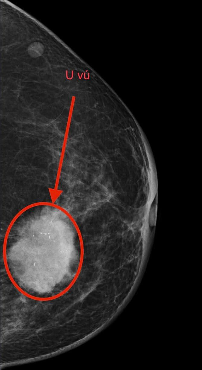 Kết quả thăm của bệnh nhân ung thư tuyến vú đã di căn hạch. Ảnh BVCC