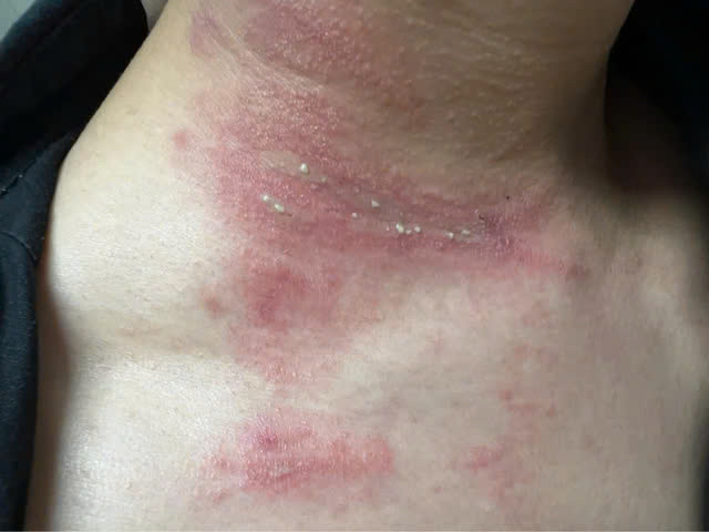 Nam bệnh nhân bị nọc độc của kiến ba khoang lan khắp vùng cổ. Ảnh SK&amp;ĐS