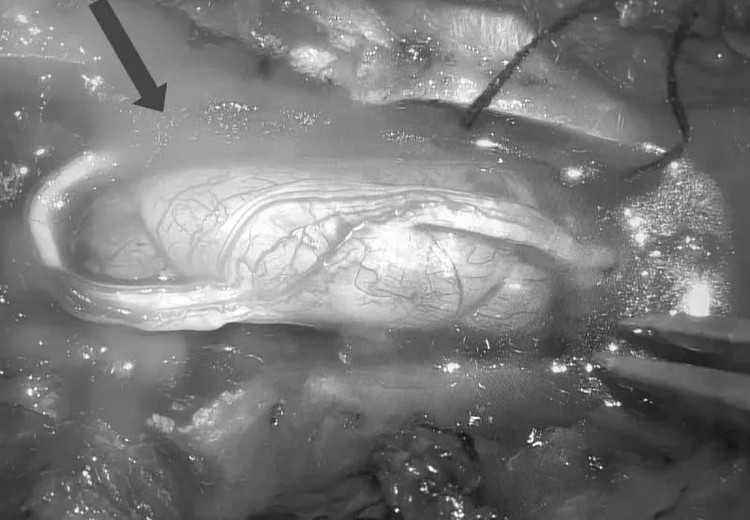 Hình ảnh khối u tuỷ trong ống sống ngực đoạn ngang T6T7 kích thước (1,5 x 2 cm) của bệnh nhân. Ảnh BVCC