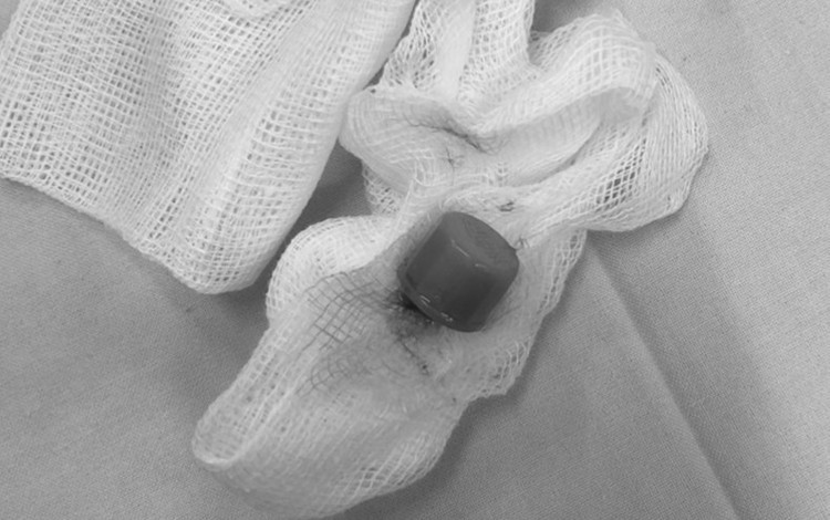 Nắp dầu gió lấy từ lỗ mở khí quản bệnh nhân. Ảnh BVCC