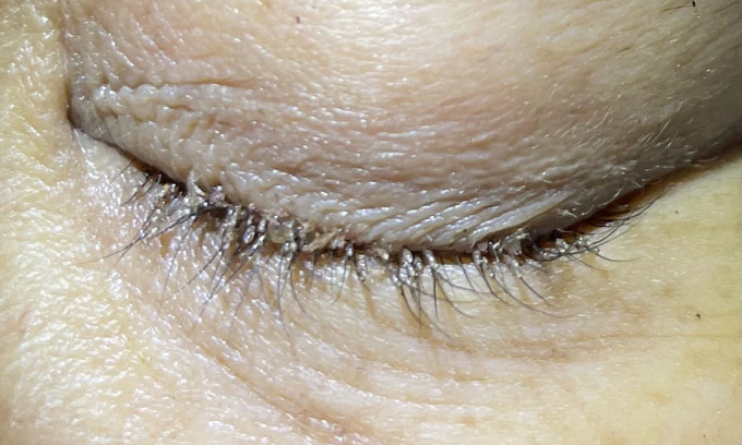 Hàng chục con rận, bám chi chít trên mi mắt người phụ nữ 50 tuổi. Ảnh BVCC