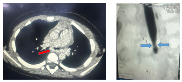 CT scan ngực mặt cắt ngang thấy động mạch phổi trái quấn hẹp khí quản gốc, mặt cắt dọc đứng thấy hẹp khí quản gốc (carina). Ảnh BVCC CT scan ngực mặt cắt ngang thấy động mạch phổi trái quấn hẹp khí quản gốc, mặt cắt dọc đứng thấy hẹp khí quản gốc (carina). Ảnh BVCC