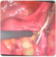 Vòng tránh thai &quot;lạc chỗ&quot; trong bụng cụ bà 40 năm. Ảnh TTYT huyện Thanh Ba