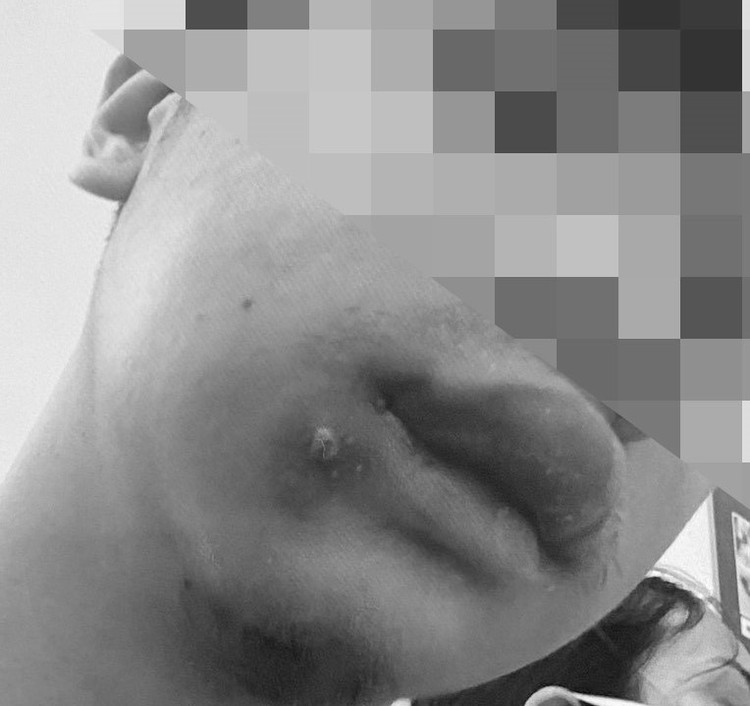 Hình ảnh tổn thương vùng môi má trái của bệnh nhân. Ảnh BVCC