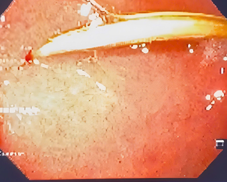 Dị vật được phát hiện tại hành tá tràng của bệnh nhân. Ảnh BVCC