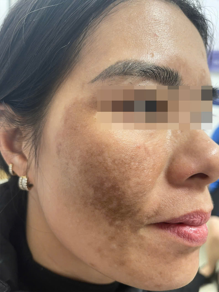 Tổn thương trên mặt bệnh nhân sau liệu trình trị nám cấp tốc tại spa. Ảnh BSCC Tổn thương trên mặt bệnh nhân sau liệu trình trị nám cấp tốc tại spa. Ảnh BSCC