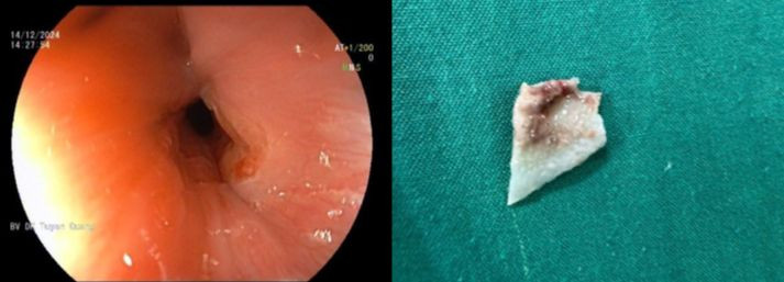 Dị vật được lấy ra từ thực quản bệnh nhi. Ảnh BVCC