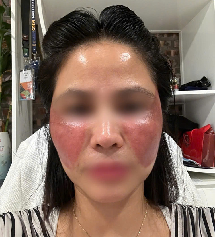 Nhiều người biến chứng nặng sau khi trị nám ở spa kém uy tín. Ảnh: Báo Dân Việt Nhiều người biến chứng nặng sau khi trị nám ở spa kém uy tín. Ảnh: Báo Dân Việt