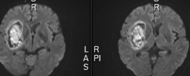 Hình ảnh phim chụp người bị xuất huyết não. Ảnh TTYT huyện Thanh Thủy