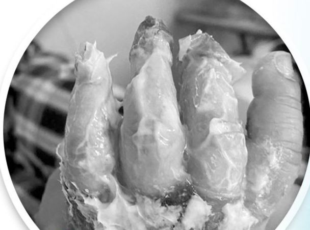 Vết bỏng của bệnh nhi. Ảnh BVCC