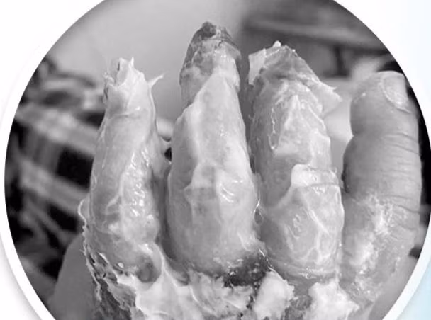 Vết bỏng của bệnh nhi. Ảnh BVCC