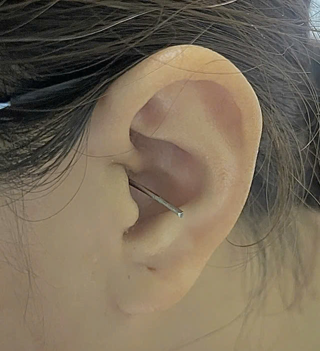 Nữ bệnh nhân bị dụng cụ lấy ráy tai đâm thủng màng nhĩ do va chạm. Ảnh: SK&amp;ĐS