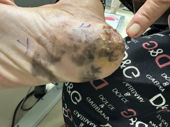 Gót chân mang vết đen lạ đi khám bất ngờ phát hiện ung thư. Ảnh BVCC