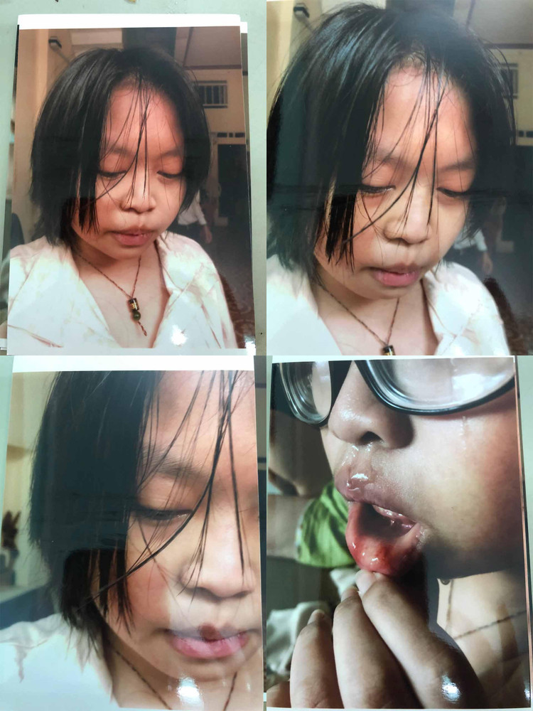 Bé Đặng Huỳnh Minh Thy bị bà Lê Thị Thanh Hà đánh đập, bạo hành tại nhà ông bà nội bé.