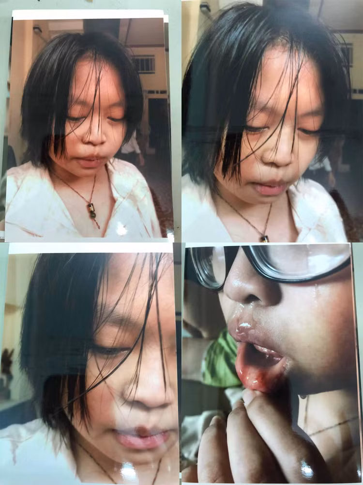 Bé Đặng Huỳnh Minh Thy bị bà Lê Thị Thanh Hà đánh đập, bạo hành tại nhà ông bà nội bé.