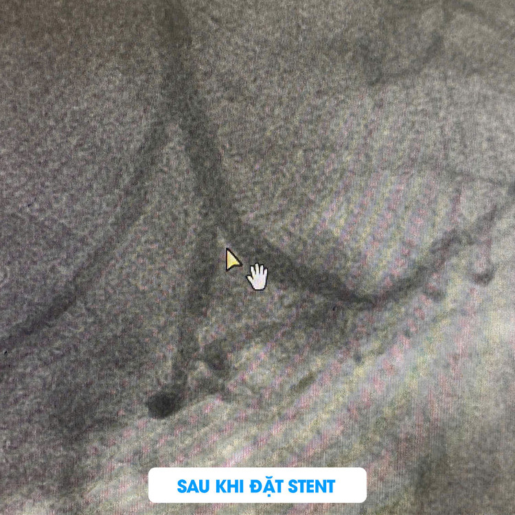 Đau ngực dữ dội... cảnh báo căn bệnh nguy hiểm không nên chủ quan ảnh 2