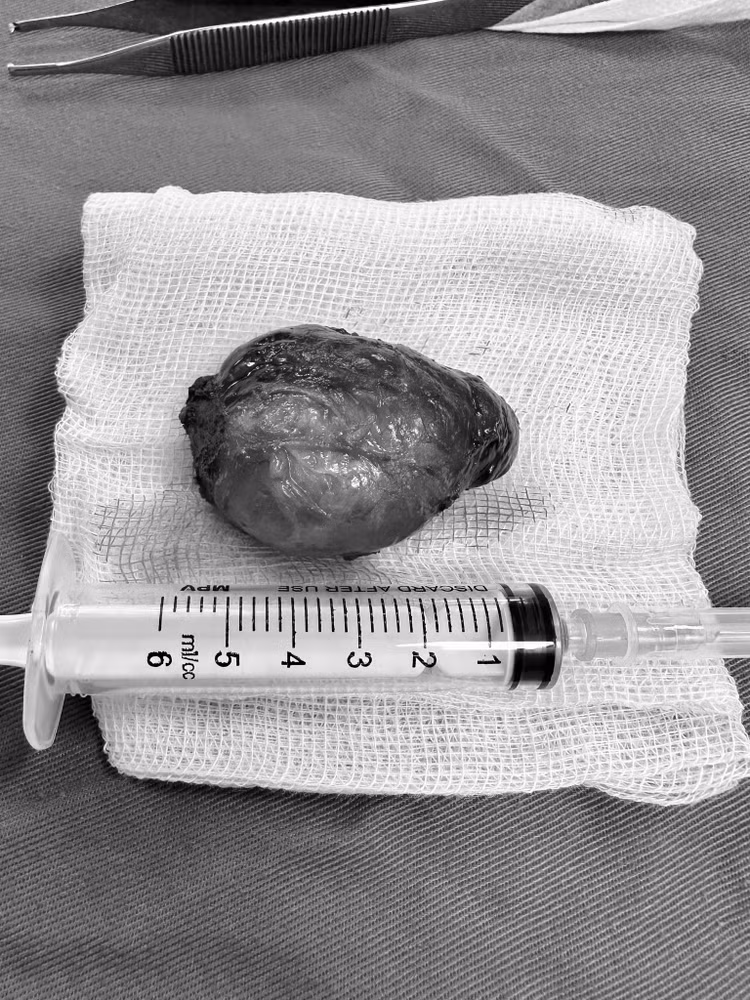 Khối u tuyến giáp khổng lồ "đeo bám" suốt 4 năm trên cổ nữ sinh. Ảnh BVCC