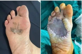 Phát hiện sớm ung thư da từ vết đen lâu năm trên bàn chân