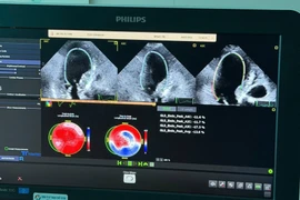 Siêu âm tim gắng sức, phát hiện sớm thiếu máu, tránh nhồi máu cơ tim