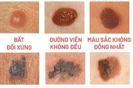 Cắt nốt ruồi bỏ qua xét nghiệm mô bệnh học cẩn thận ung thư