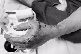 Cắt gỗ tại nhà, người đàn ông bị tai nạn cưa cắt suýt mất chức năng bàn tay